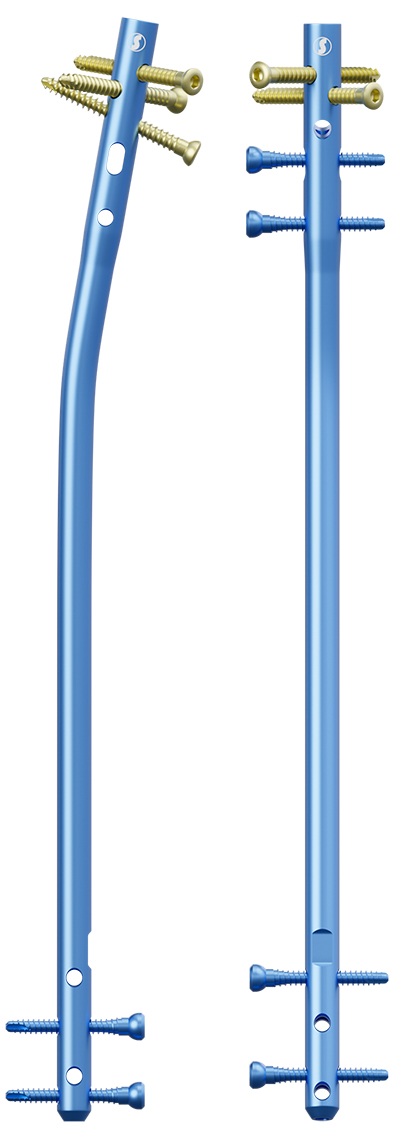 Стрижень великогомілковий канюльований блокуючий-ІІ